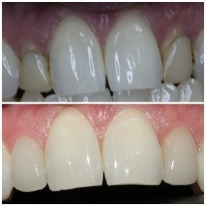 Before and after dental photo: top row shows damaged teeth, bottom row shows repaired teeth with white crowns.