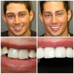 Before and after photos of a man's smile, showing the impact of cosmetic dental work to straighten and whiten teeth.