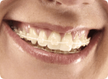 Straighten Teeth