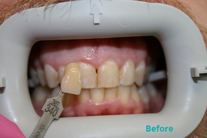 Before zoom whitening treatment