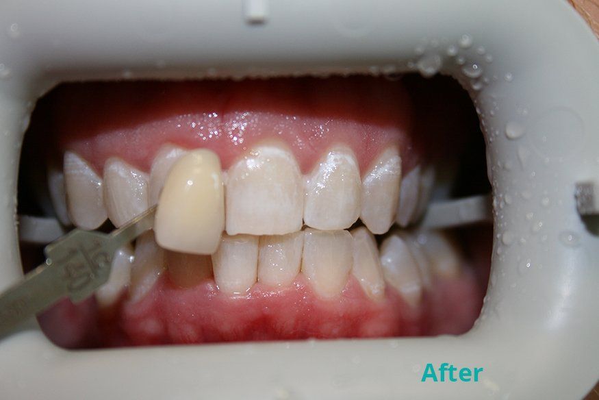 After zoom whitening treatment