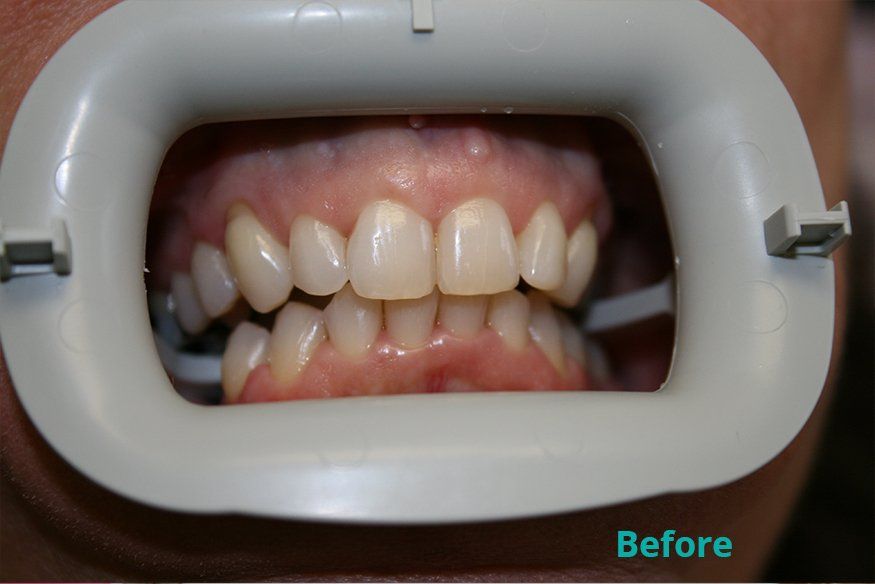 Before zoom whitening treatment