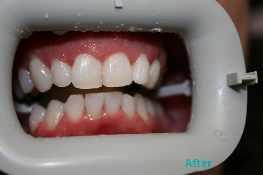 After zoom whitening treatment