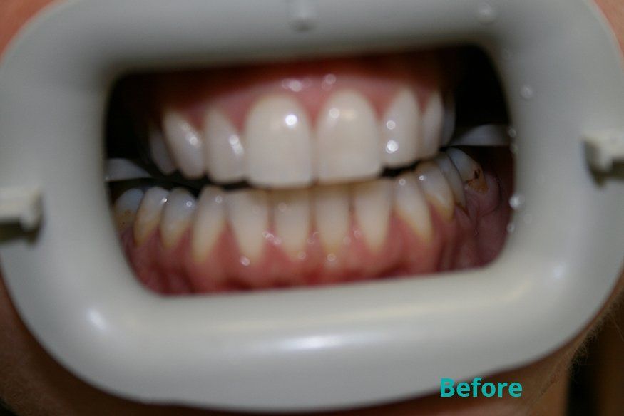 Before zoom whitening treatment