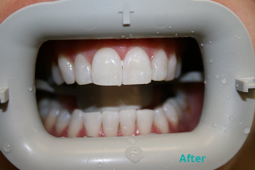 After zoom whitening treatment