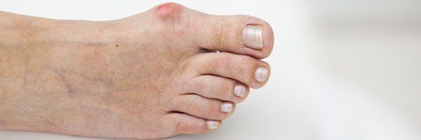Painful foot injury
