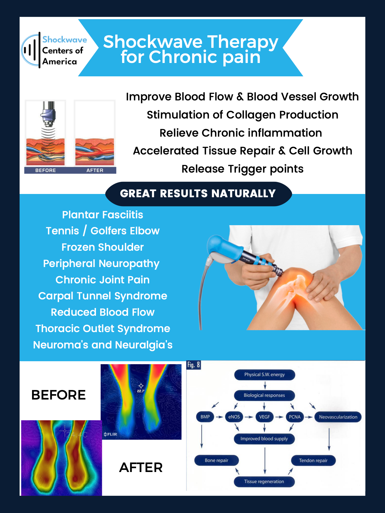 Shockwave Therapy for chronic pain.