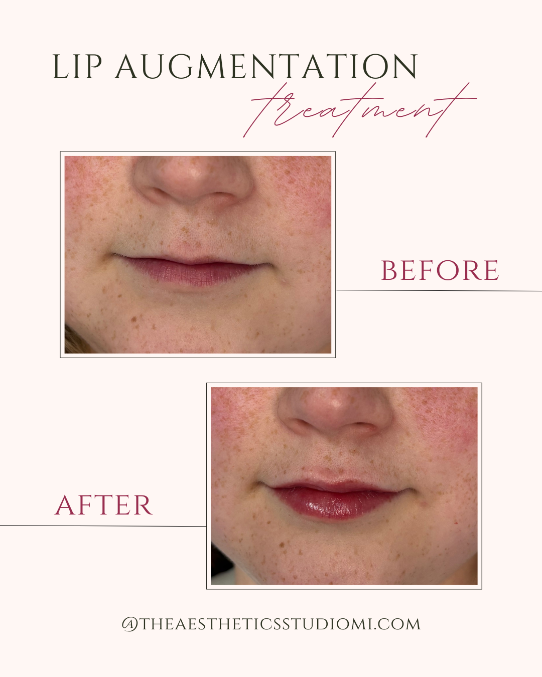 Lip augmentation promo with before-and-after close-ups of lips, showing fuller, glossier lips after treatment
