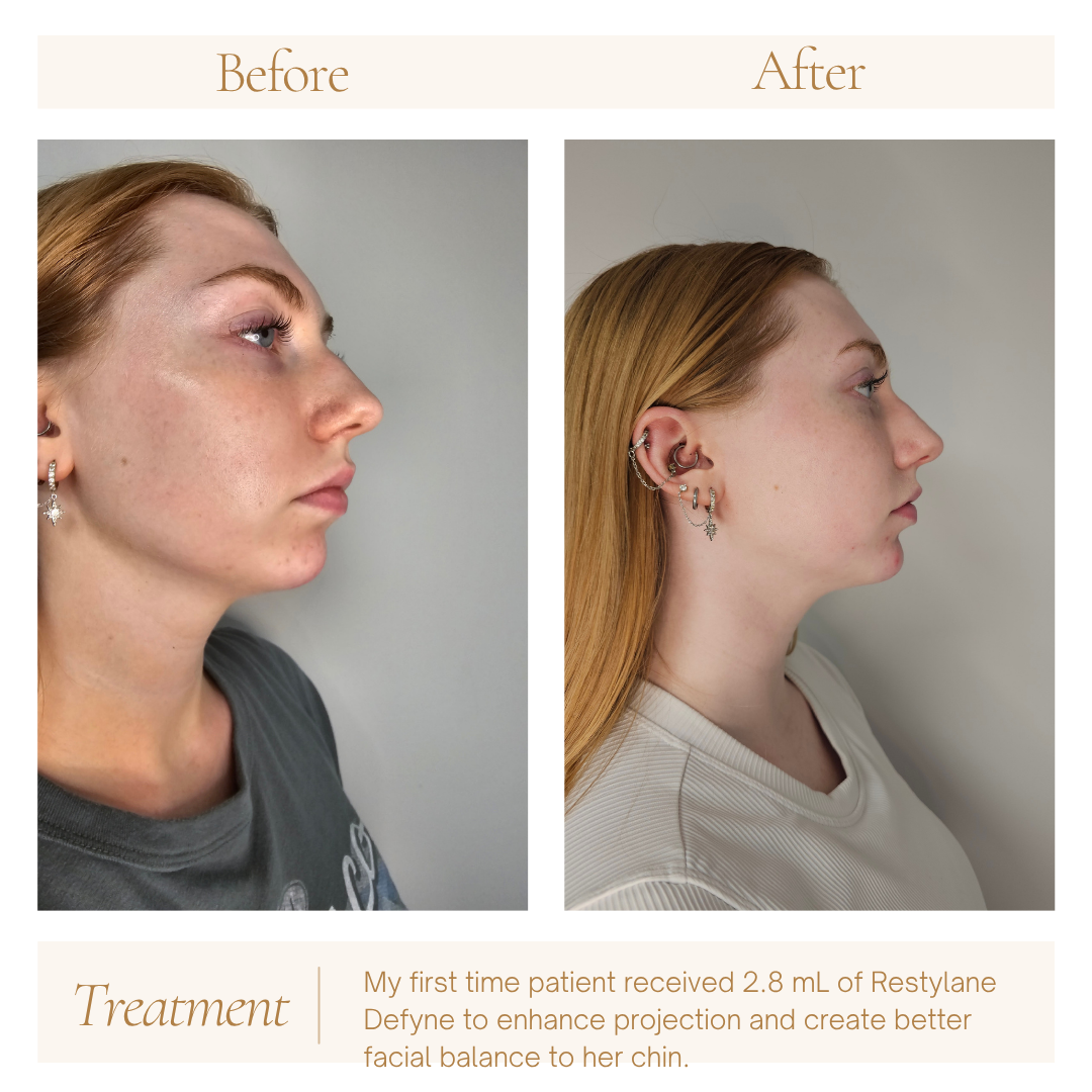 Before-and-after side-profile photos showing treatment results for a nasal profile change.