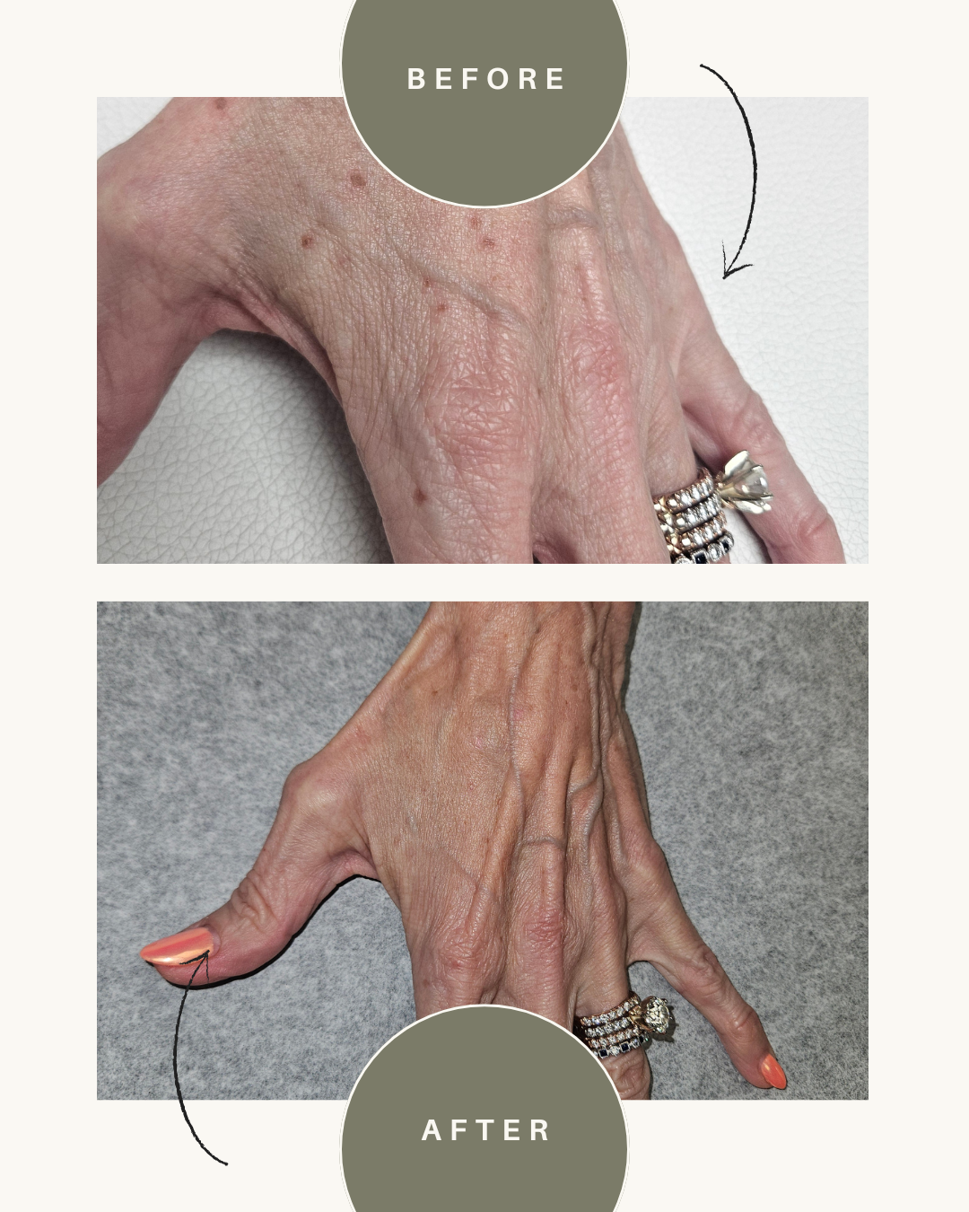 Before-and-after hands showing improved thumb extension and wrist posture against a white background.