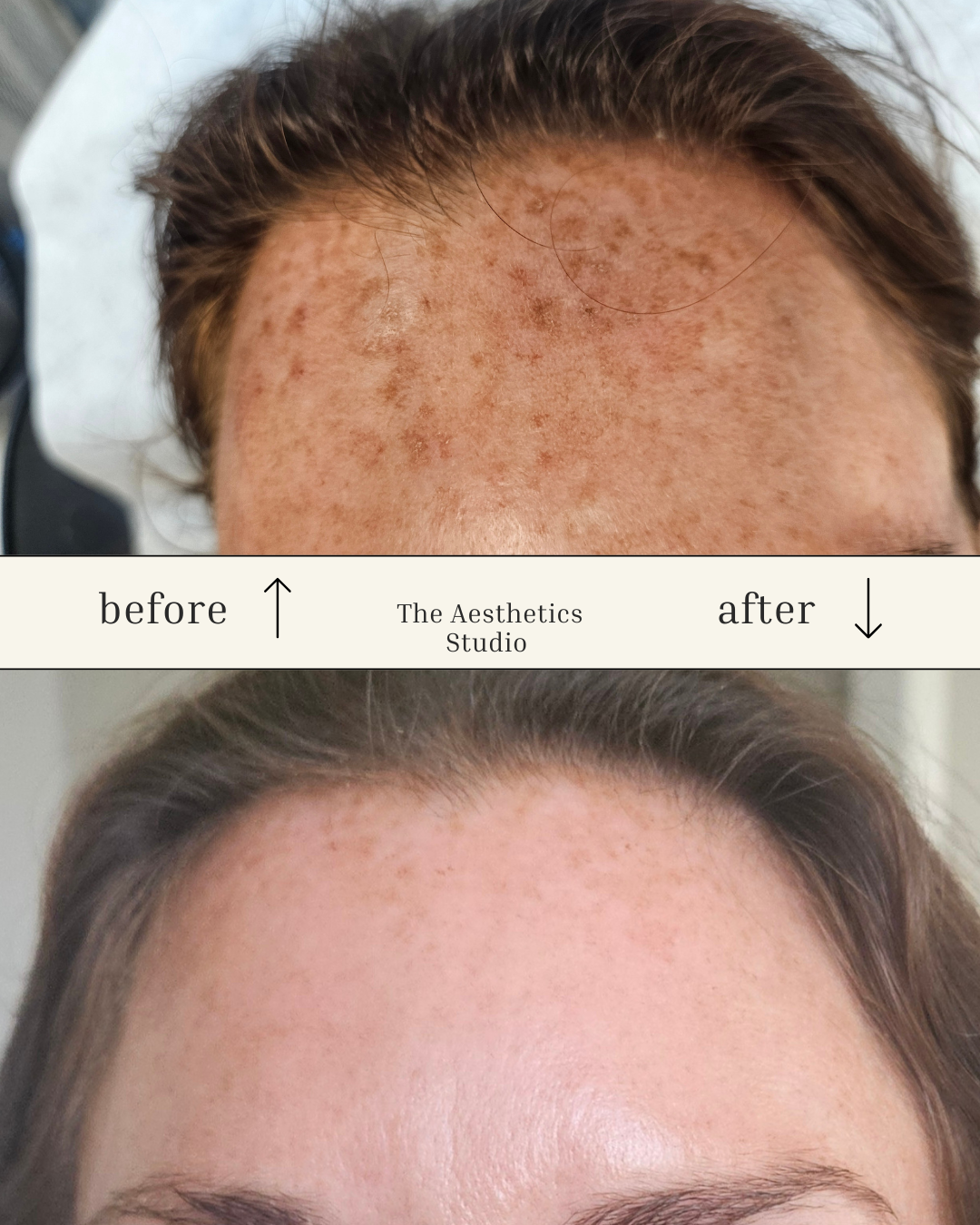 Before-and-after close-up of forehead skin showing reduced spots after treatment
