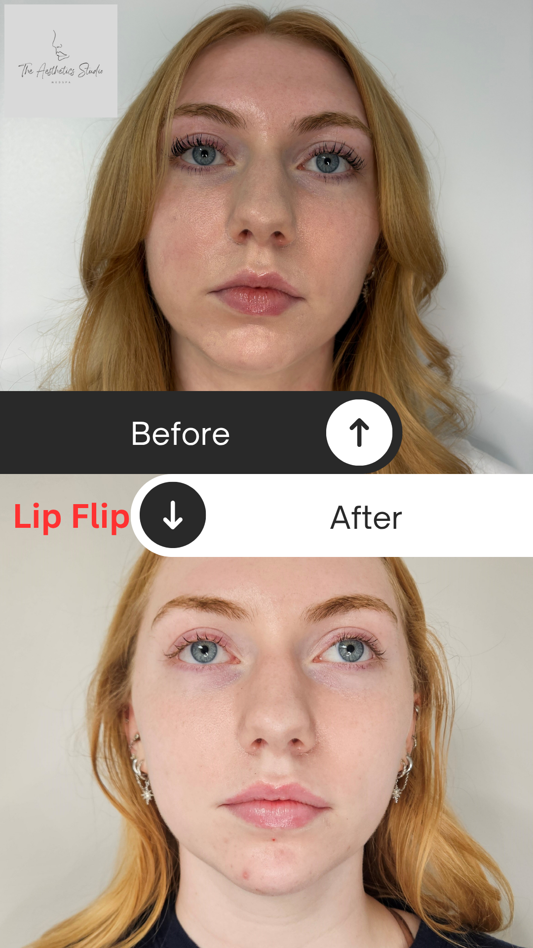 Before-and-after close-up of glossy pink lips, showing improved fullness and shine.