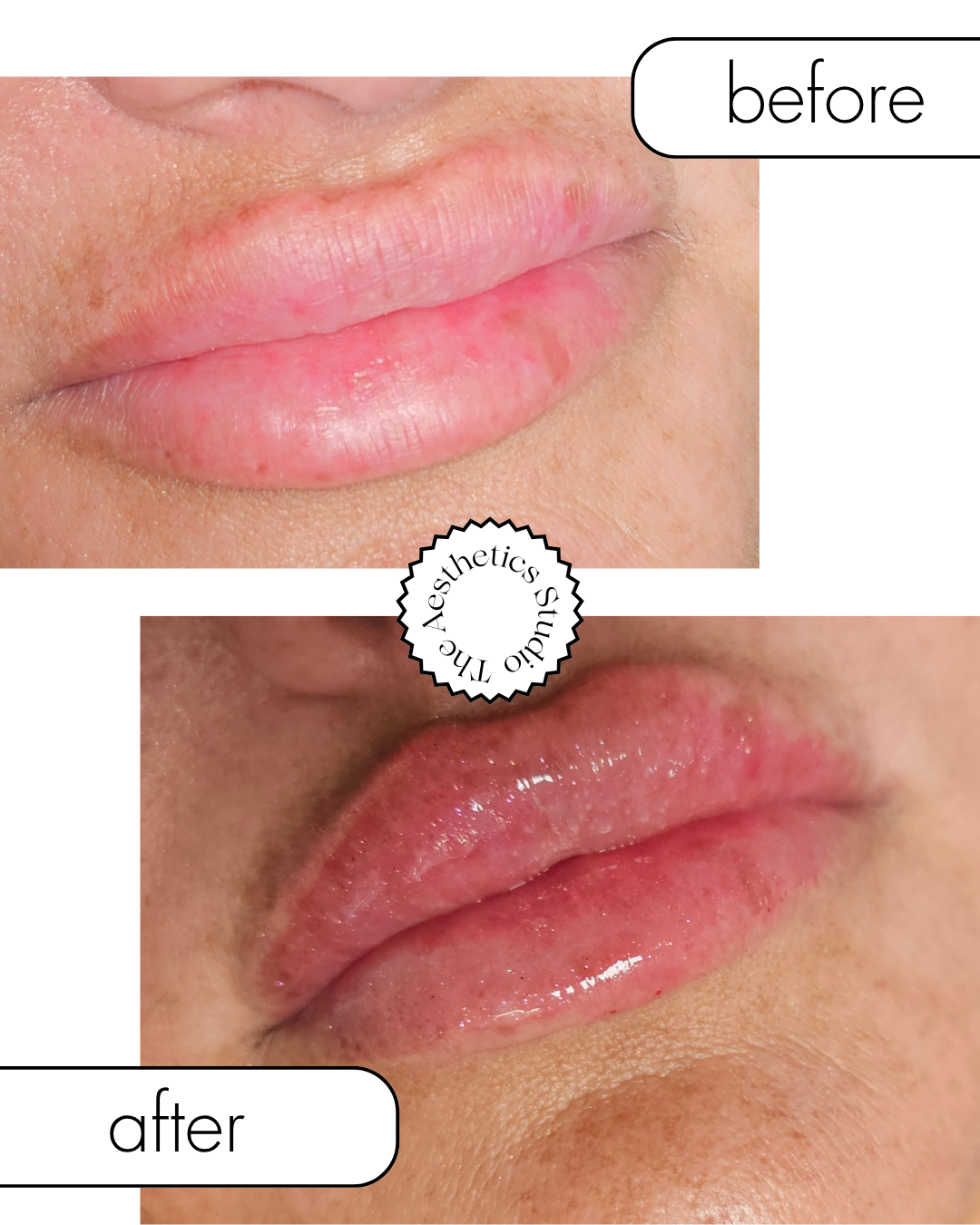 Before-and-after close-up of glossy pink lips, showing improved fullness and shine.