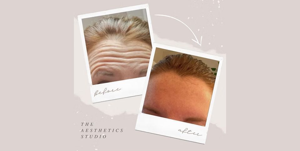 Two Polaroid-style photos showing before-and-after forehead wrinkles and smoother skin, with a curved arrow between them