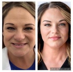 Before and after photos; woman smiling, right photo shows smoother skin and wrinkles diminished.