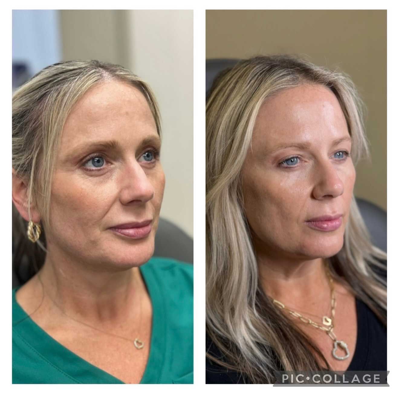 Side-by-side comparison of a person's face. Left side shows before, right shows after, with more defined features.