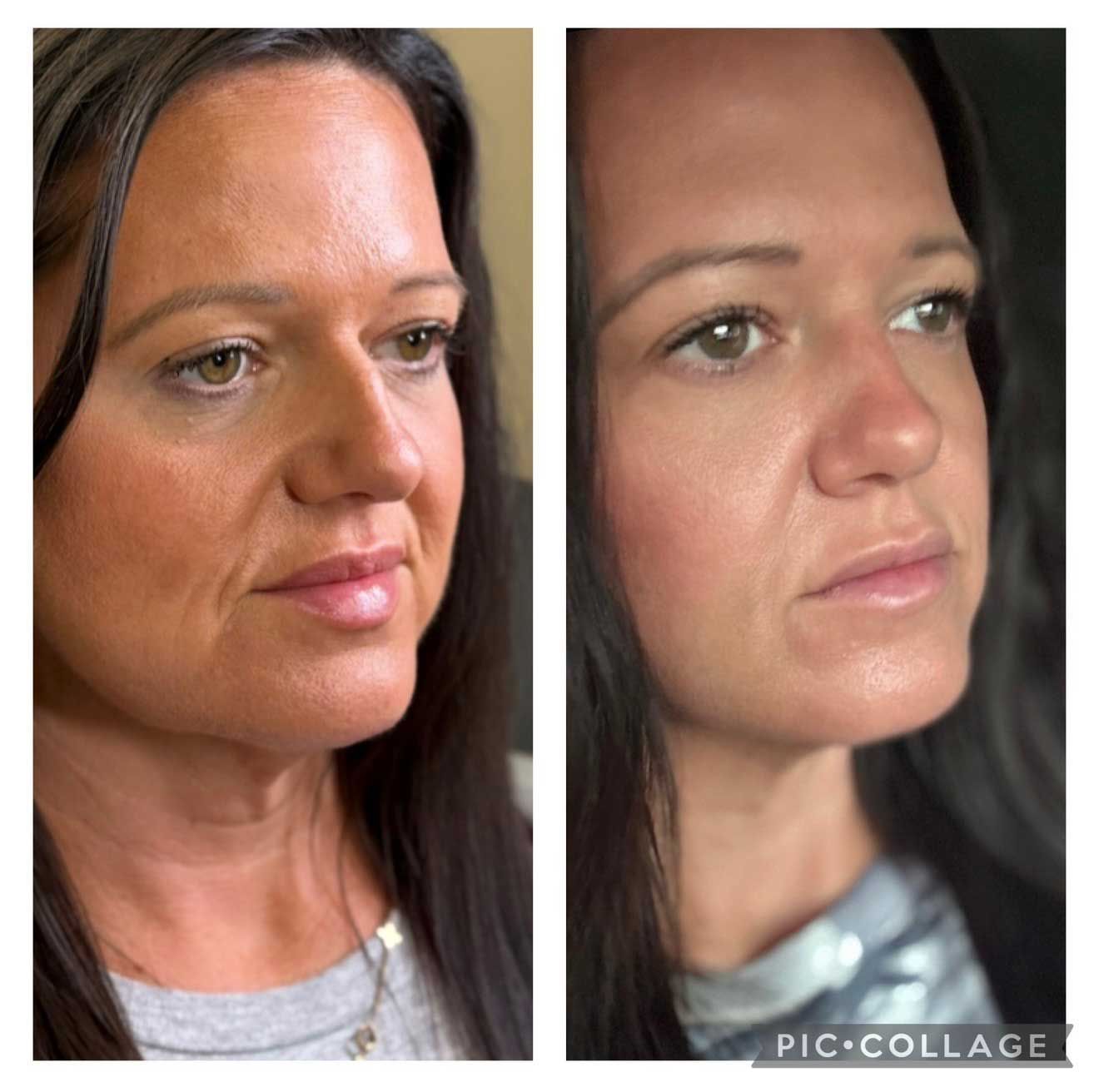 Before-and-after facial comparison. Left: Older face with wrinkles. Right: Smoother skin, less noticeable wrinkles.