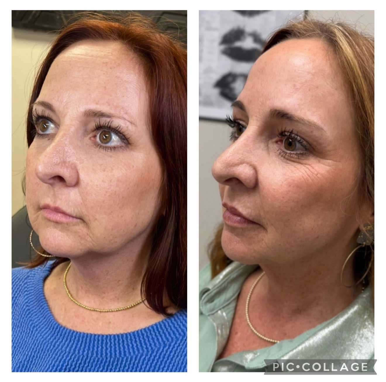 Two side-profile views of a woman's face, showing before-and-after facial treatment.