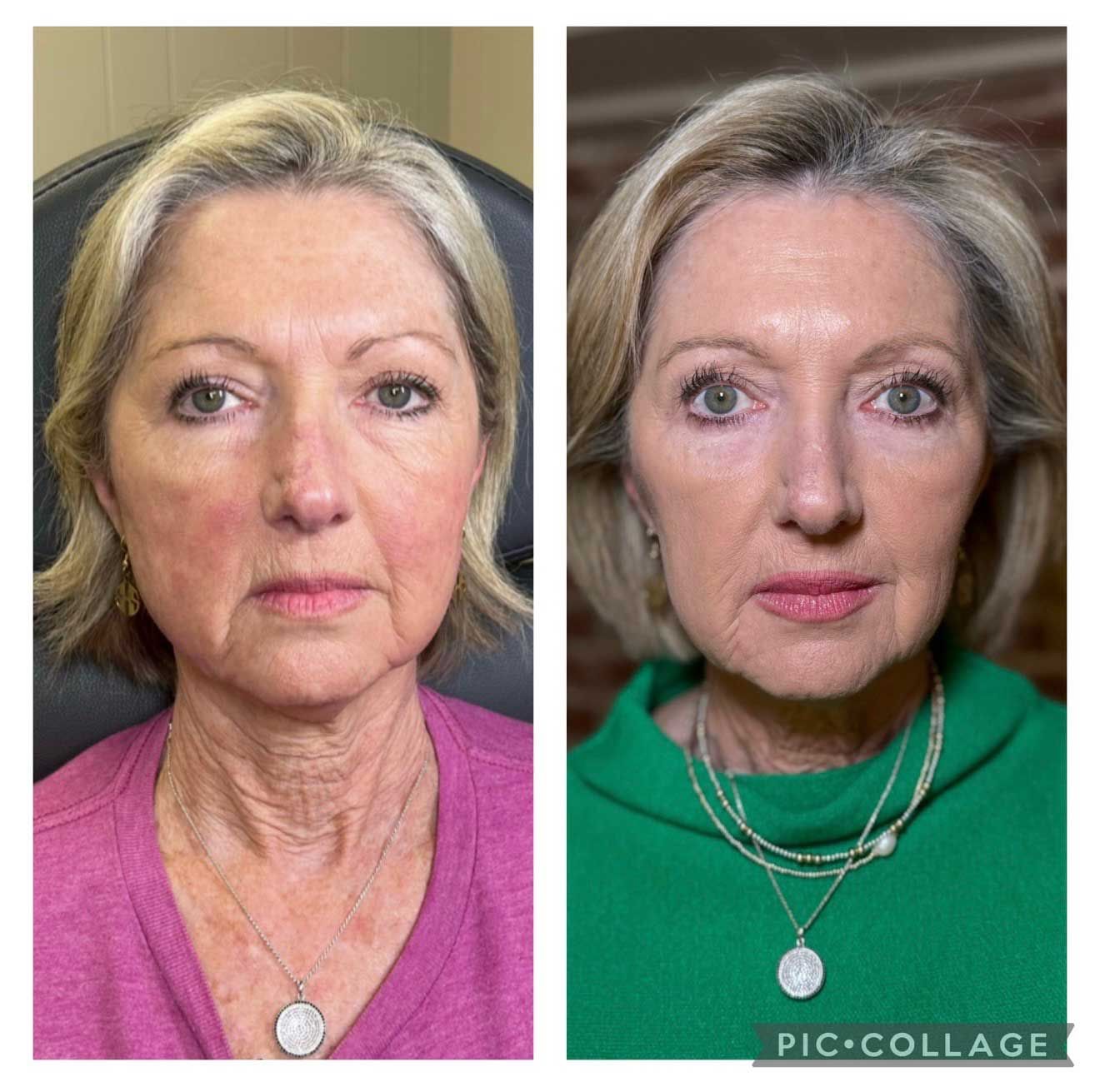 Before and after photos of a woman's face, showing a visible reduction in wrinkles after a cosmetic procedure.