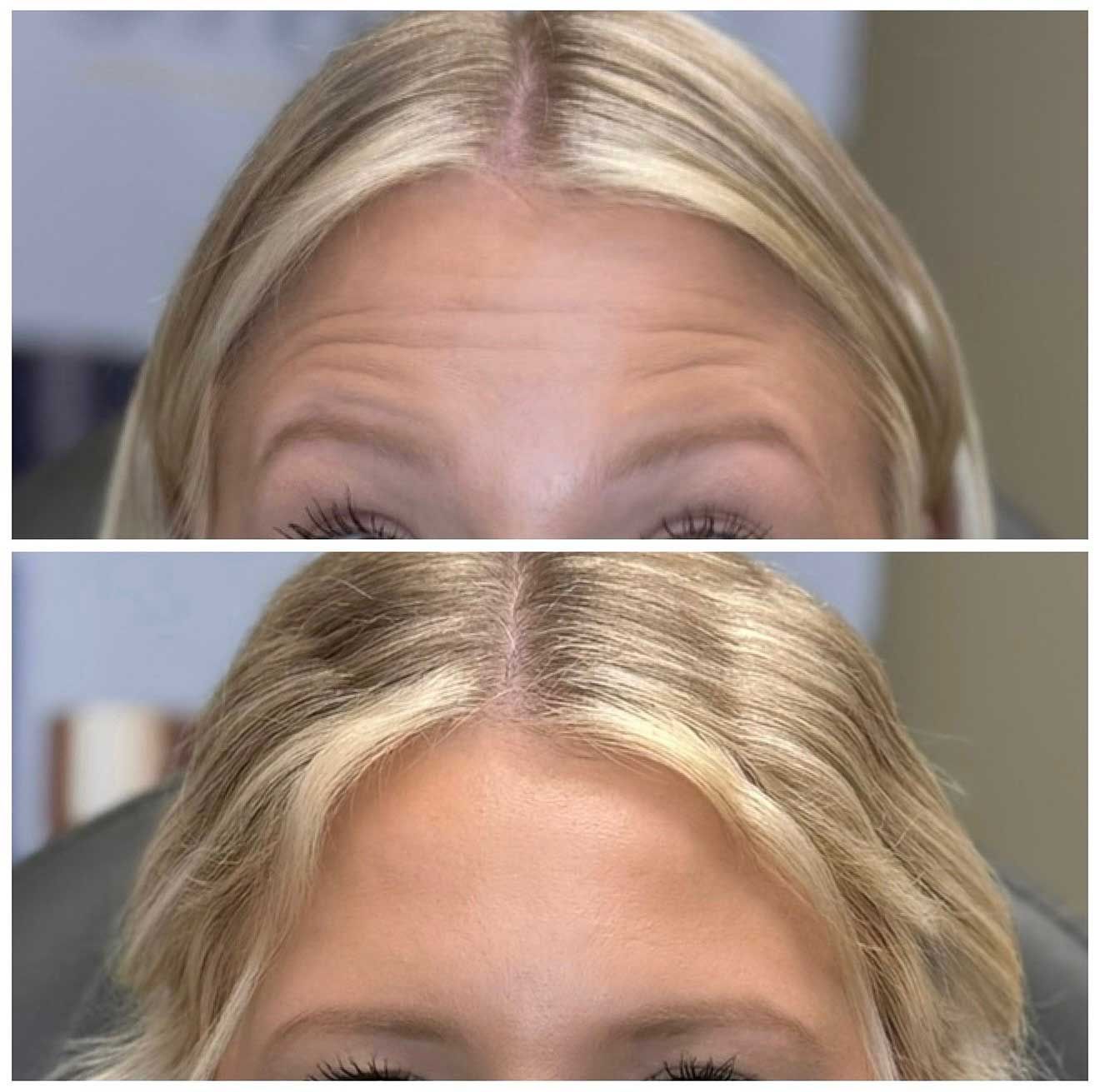 Forehead with wrinkles before and after treatment, showing smoothing effect. Blonde hair.