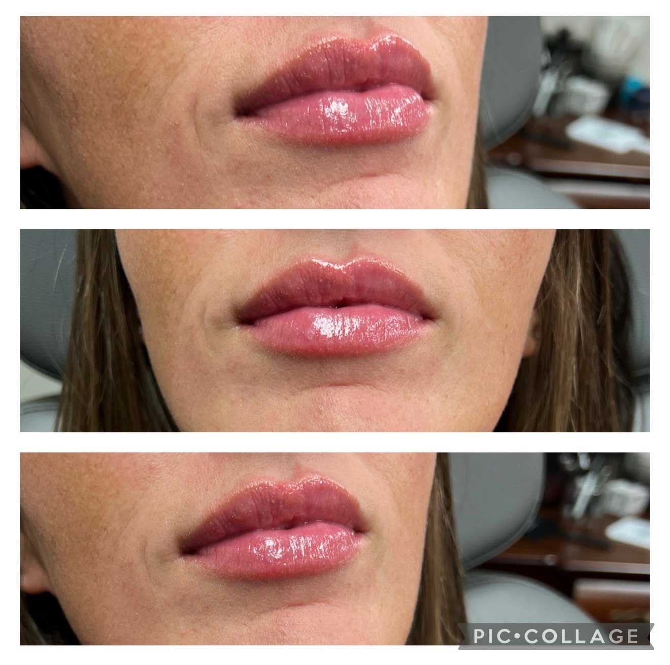 Three close-up shots of a person's lips. Lip filler is applied, showing fullness and sheen.