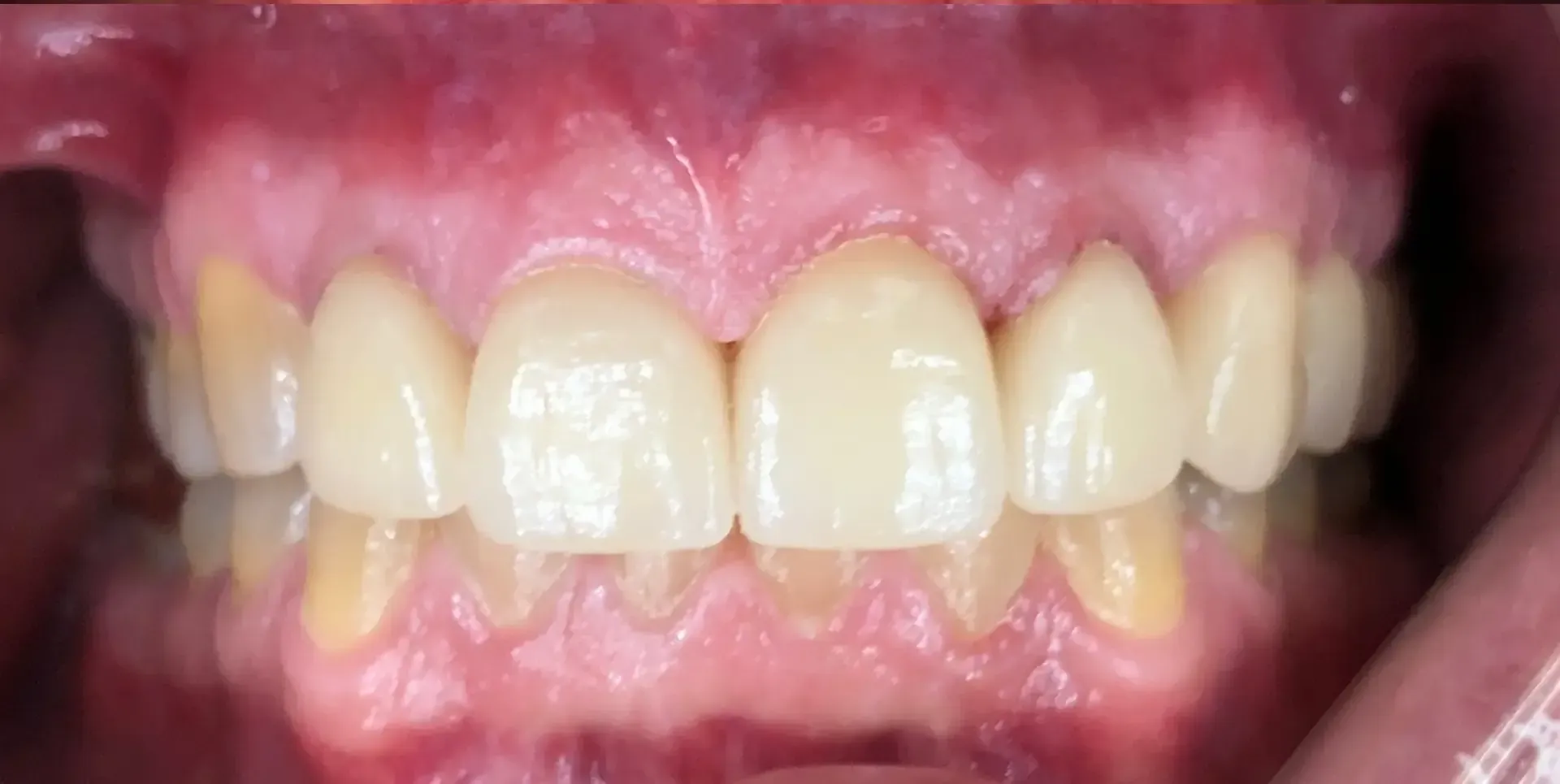 Close-up view of a person's upper and lower teeth; the teeth are yellowish-white and visible within the gums and inner mouth.