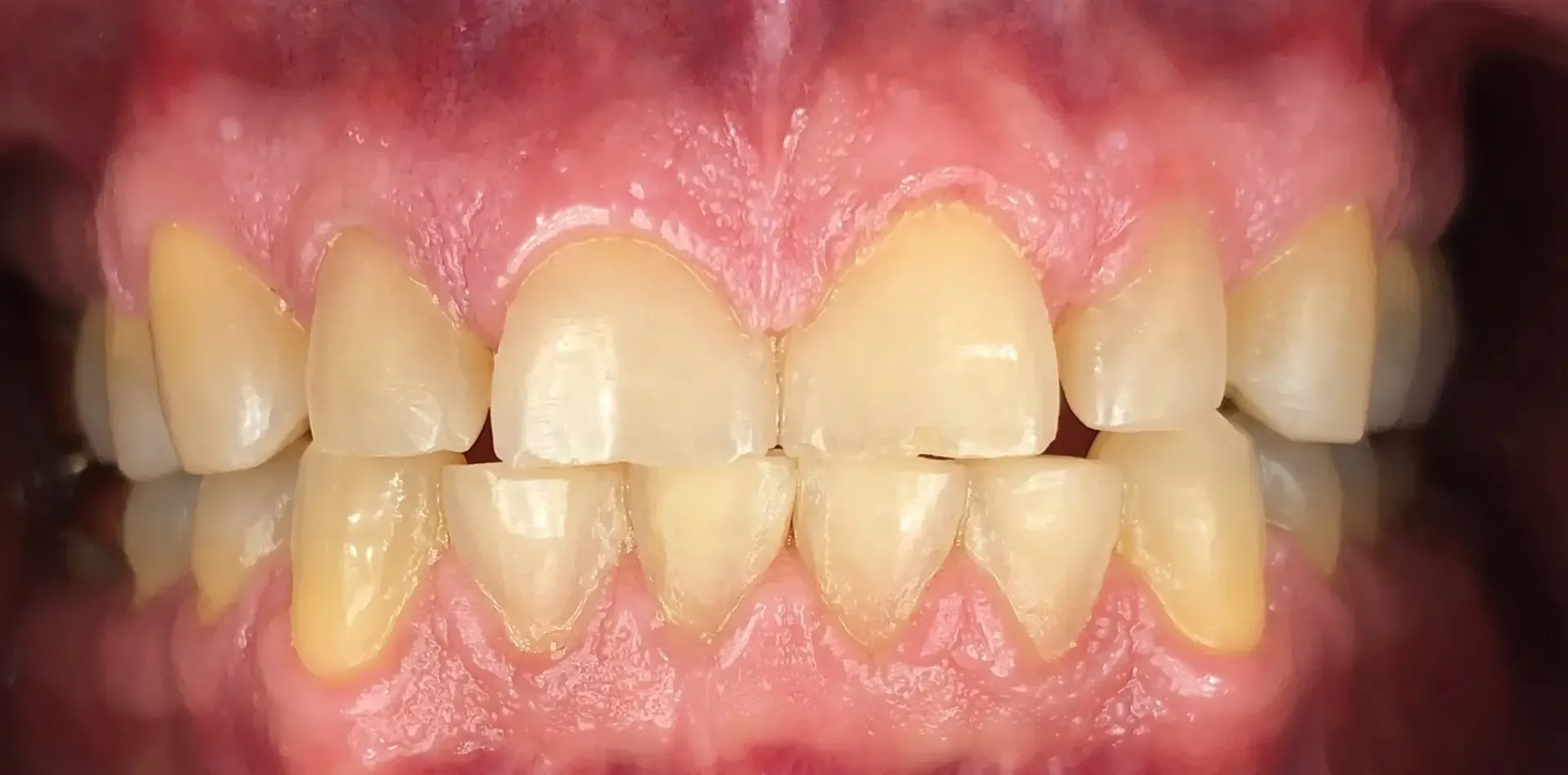 Close-up of a person's teeth; the teeth are a yellowish-white color and the gums are pink.