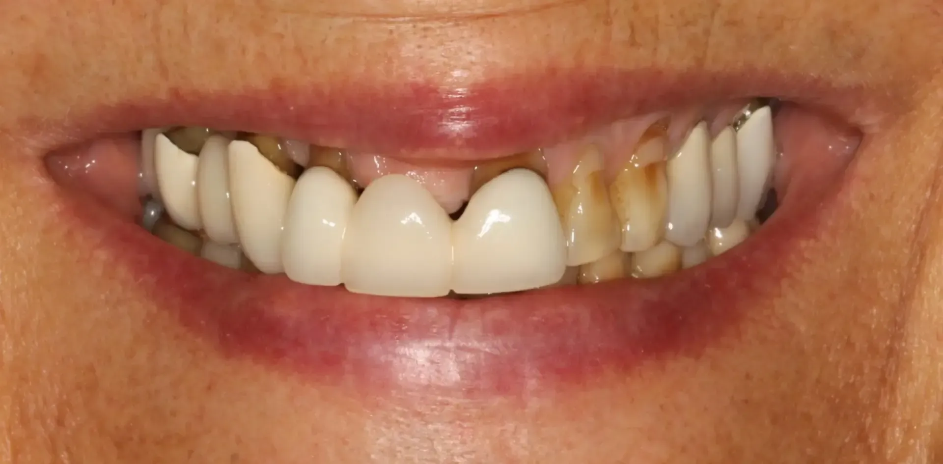 Close-up of a person's mouth showing uneven, discolored teeth and some dental work.
