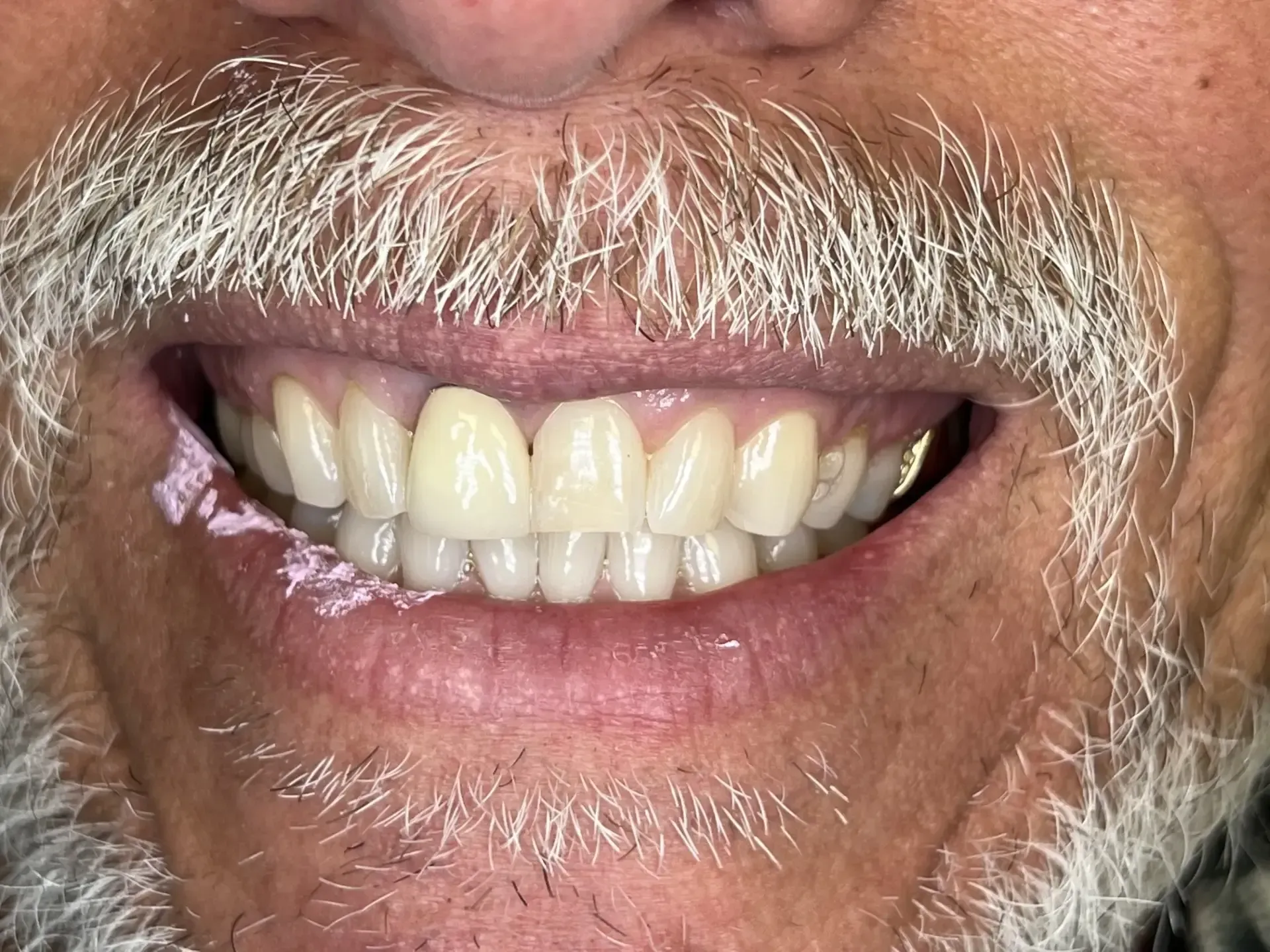 Close-up of a man smiling, revealing straight, white teeth and a gray beard. Pink substance on the left lip.