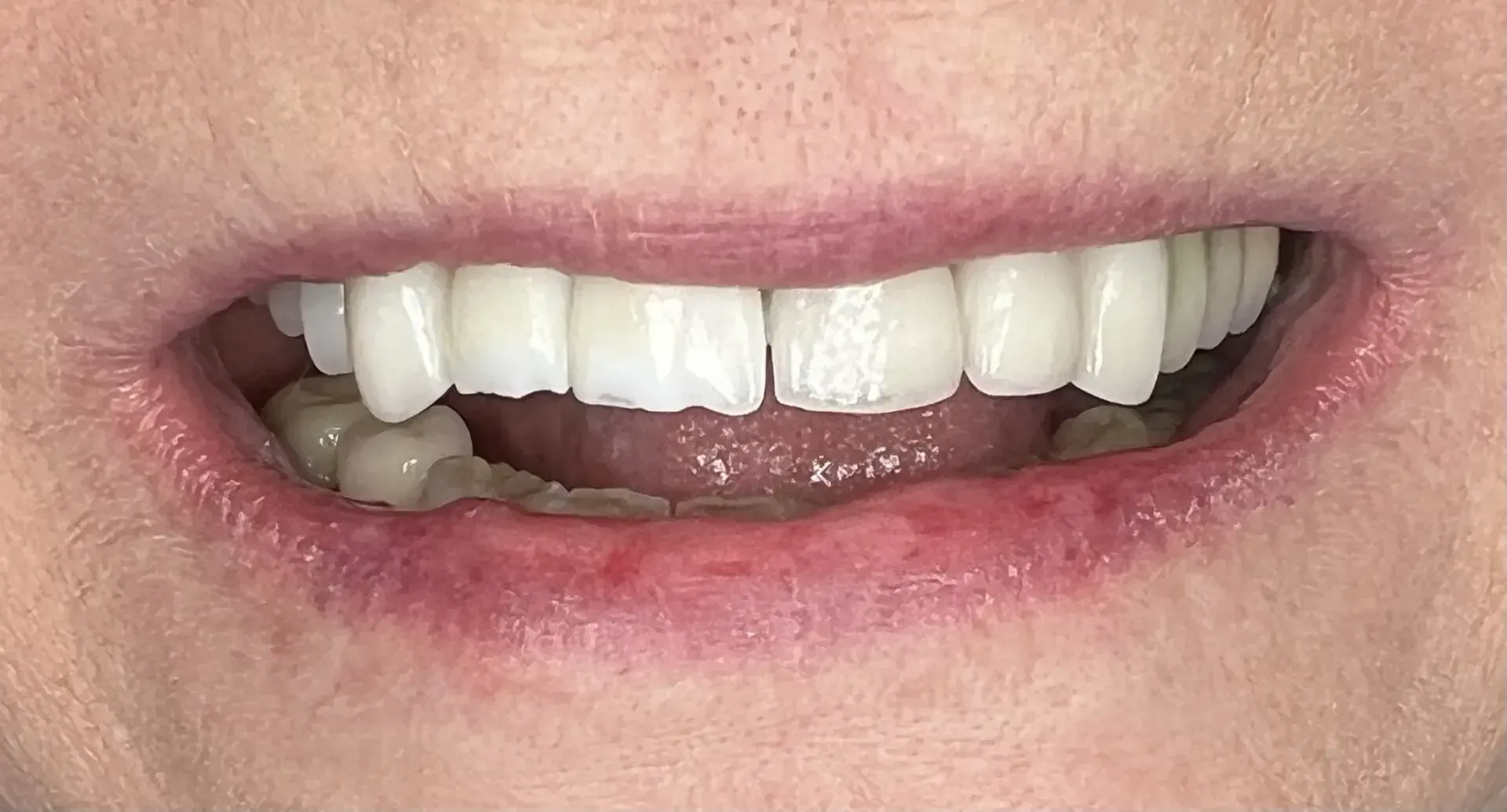 Close-up of a person's mouth showing teeth, including an off-white upper set and natural-looking lower teeth. The lips are pinkish.