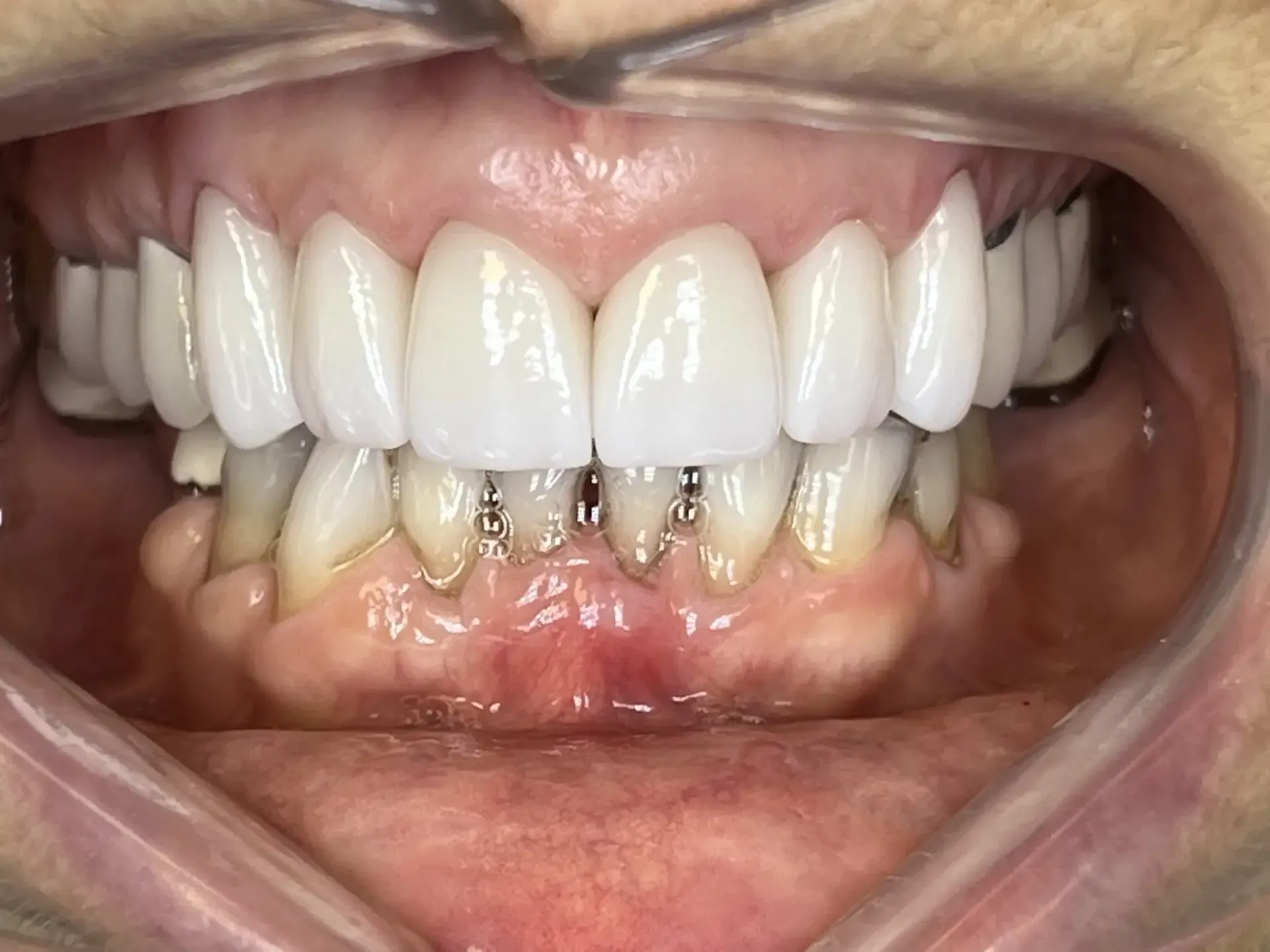 Close-up view of a person's mouth showing newly-placed, bright white dental veneers on the upper teeth and implants in the lower teeth.