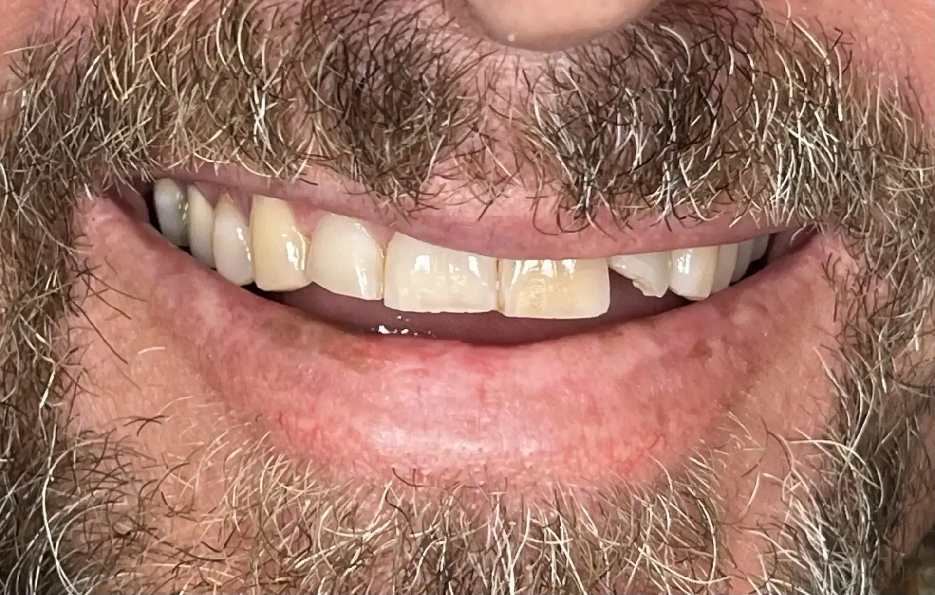 Man smiling, showing teeth; front tooth chipped and discolored, rest are white.  Beard and mustache visible.