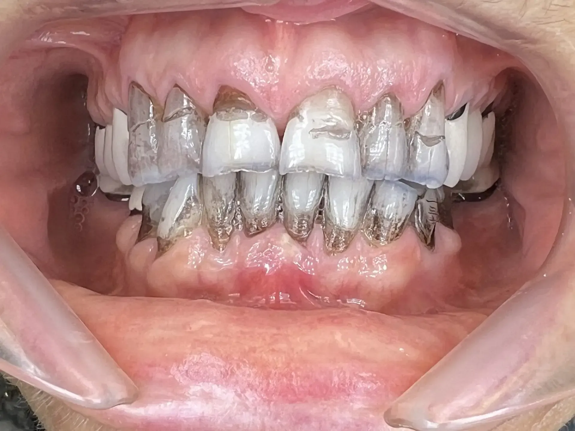 Mouth with severely decayed teeth, showing dark brown and white discoloration. The gums are slightly inflamed.