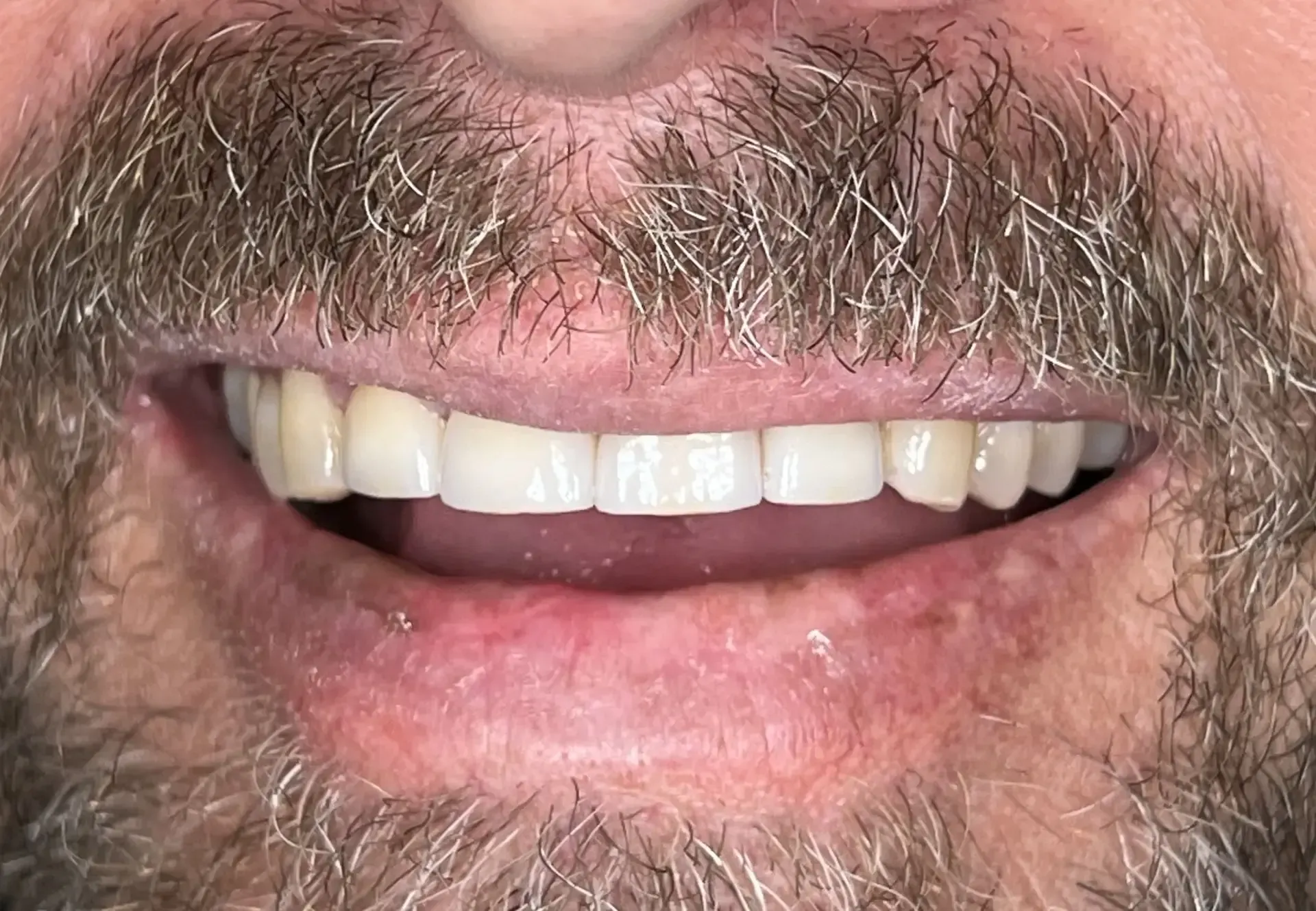 Close-up of a man smiling, showing even, white teeth. He has a beard and visible pink gums.