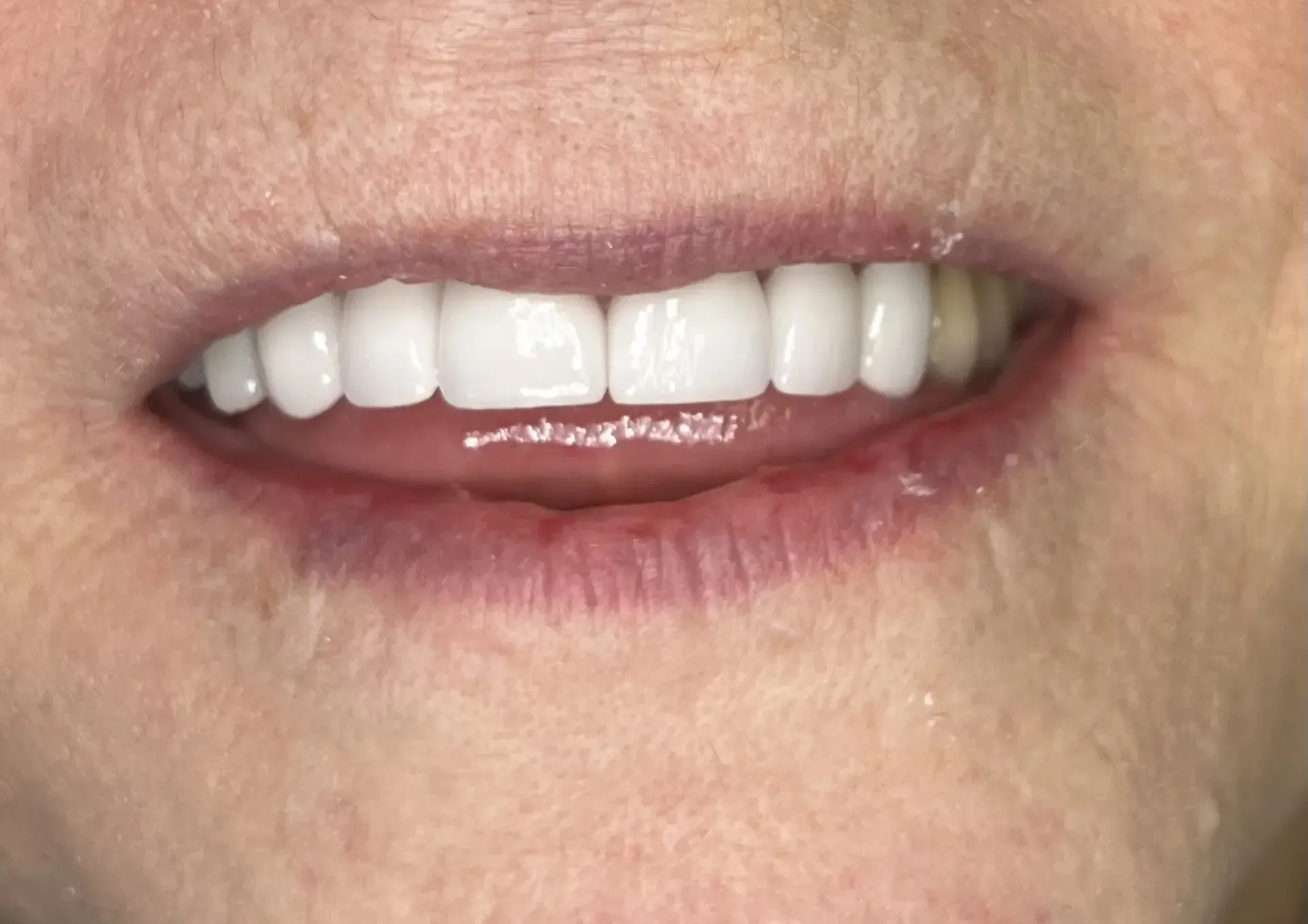 Close-up of a smiling person's mouth with bright, white teeth. The person has pinkish lips and is showing their upper teeth.