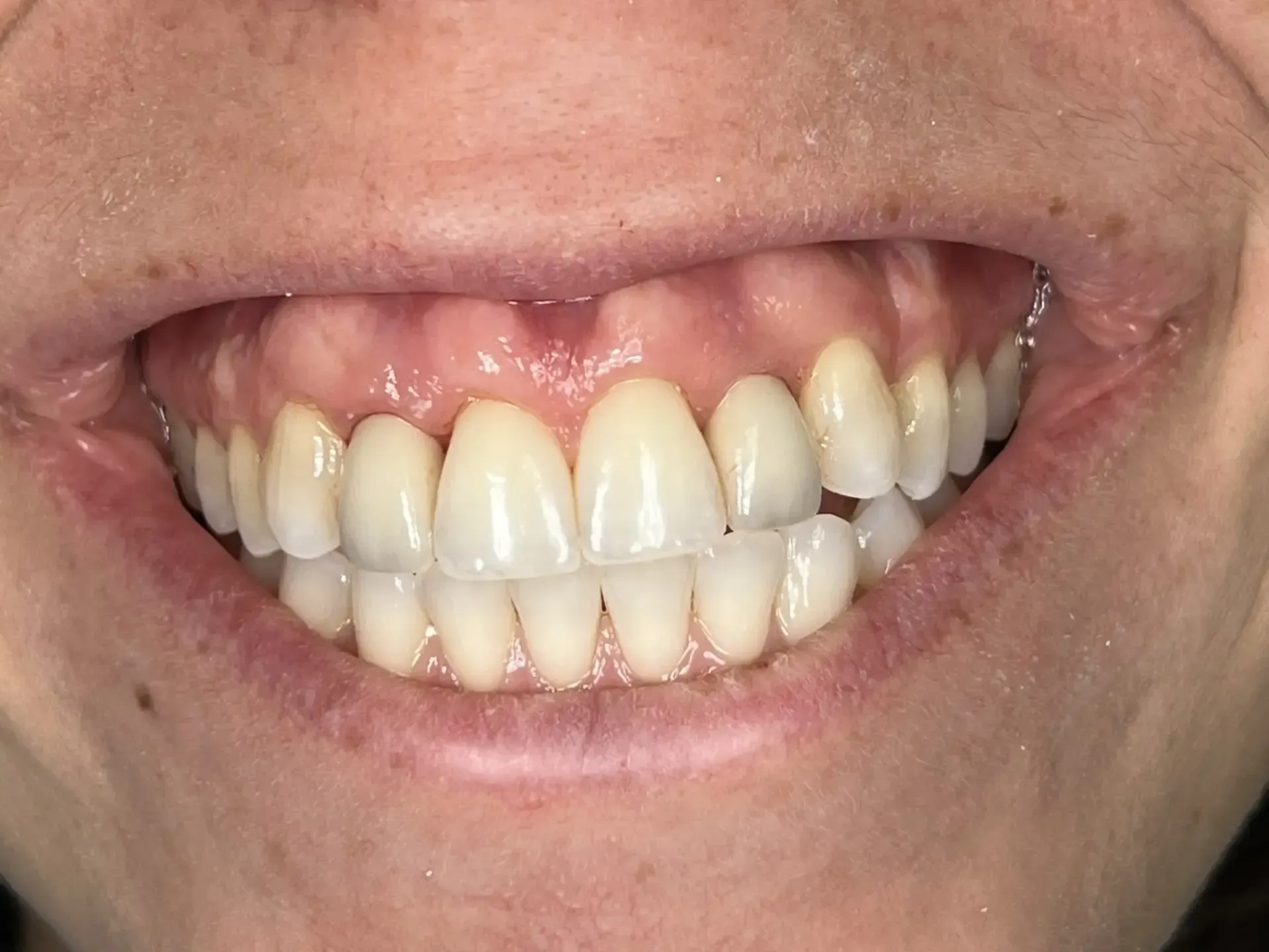A close-up shows a person's smiling mouth with bright, white teeth and pink gums.