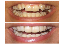 Before and after dental procedure