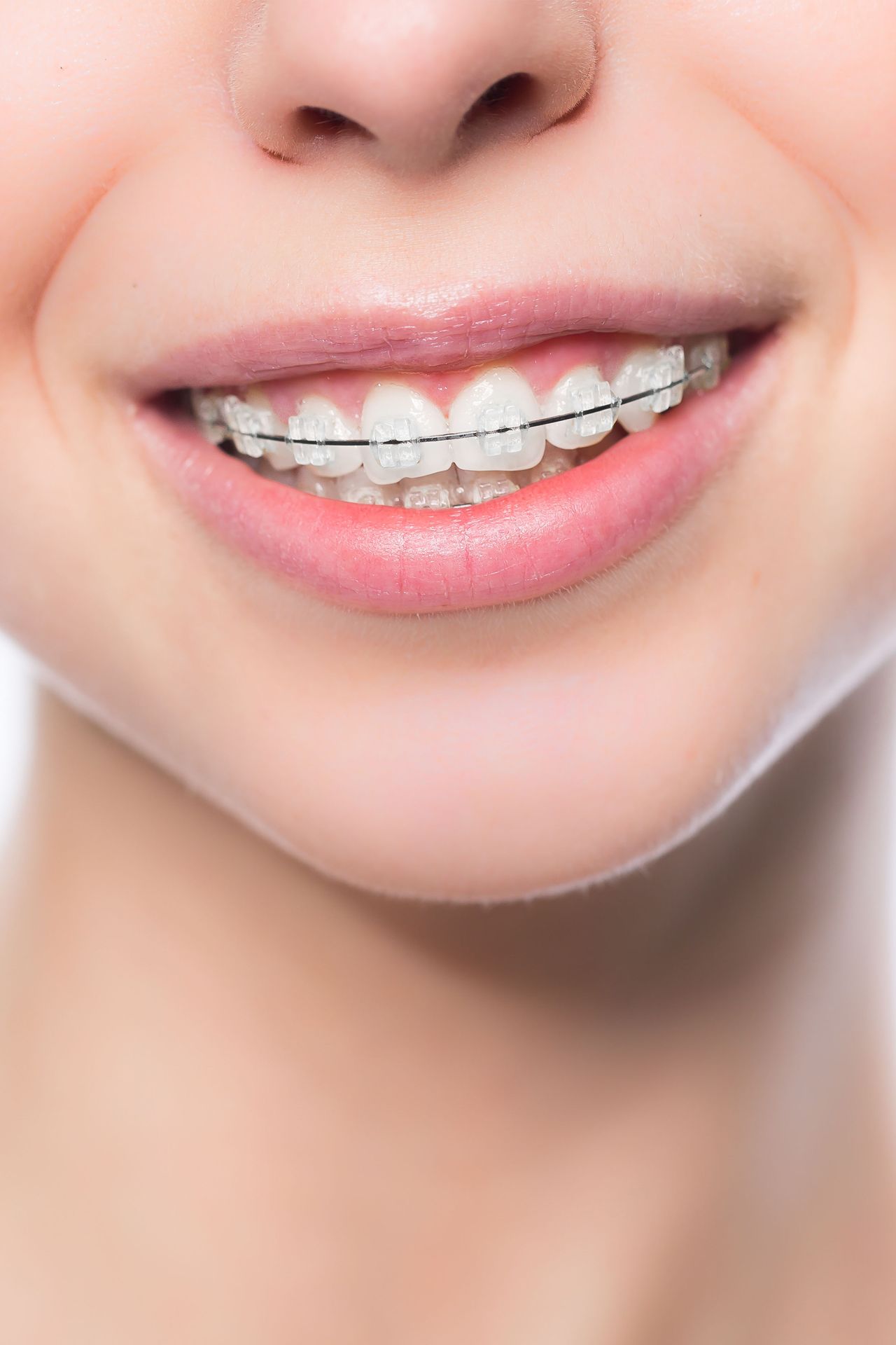 Close-up of a smiling mouth with clear braces on the teeth