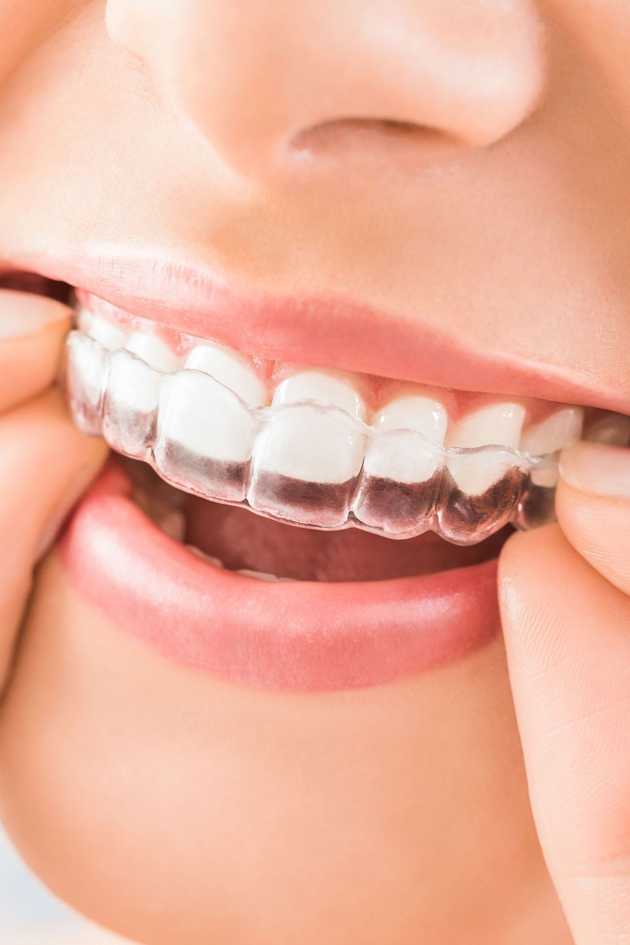Hands fitting a clear dental aligner over teeth
