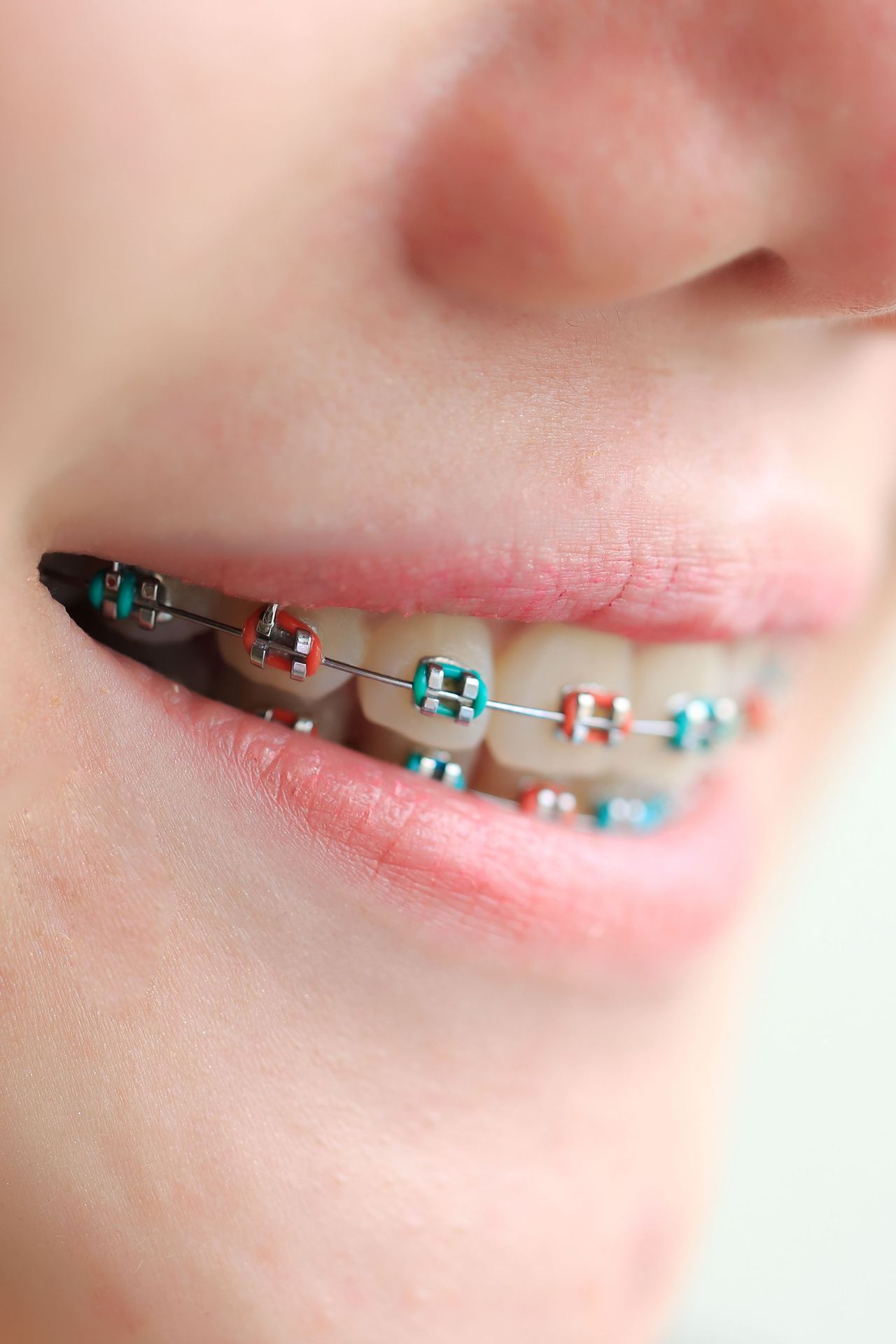 Close-up of a smiling mouth wearing colorful metal braces