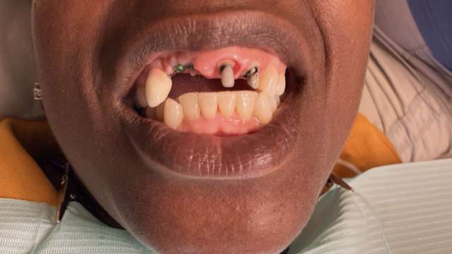 Mouth open, showing partial dentures and remaining teeth.