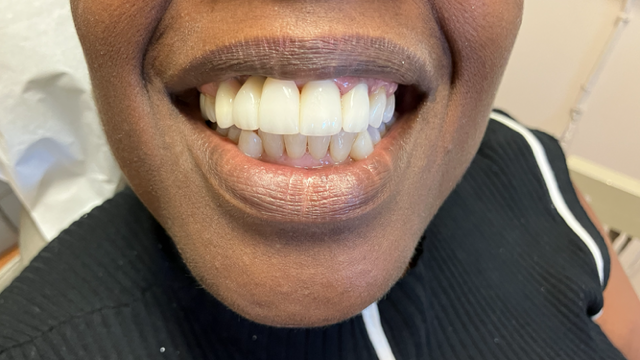 Close-up of a person smiling, showing a full set of bright white teeth.