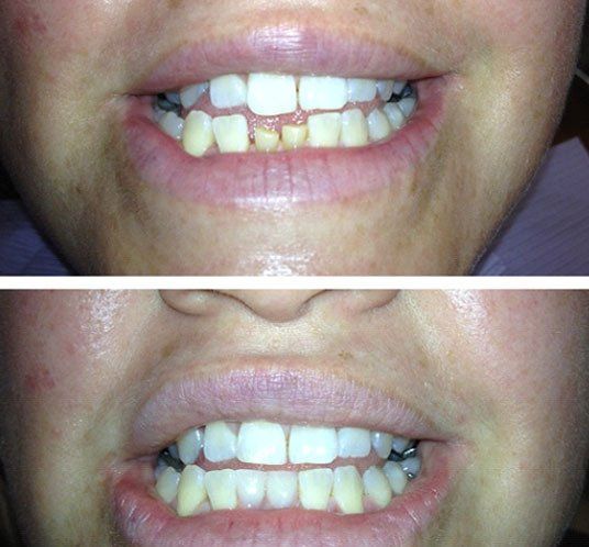 Before and after dental service