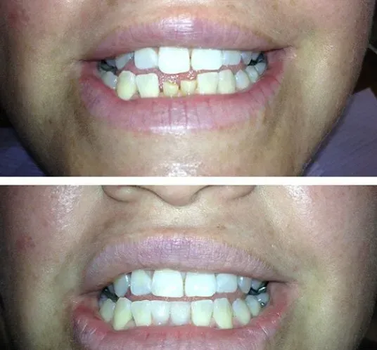 Before and after dental service