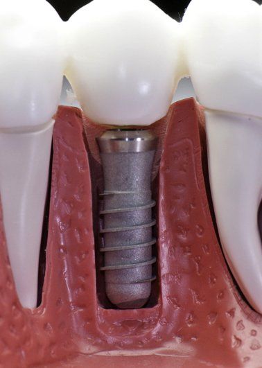 Dental implant