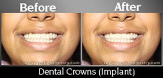 Dental  Crowns