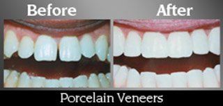 Porcelain Veneers