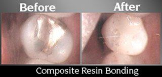 Composite resign Bonding