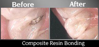 Composite resign Bonding