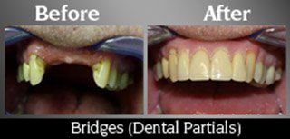 Dental Partials